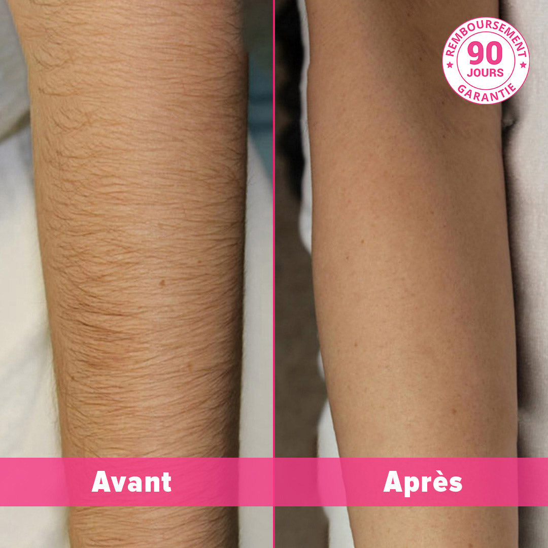 SMERTEFRI LASERHÅRFJERNING HJEMME