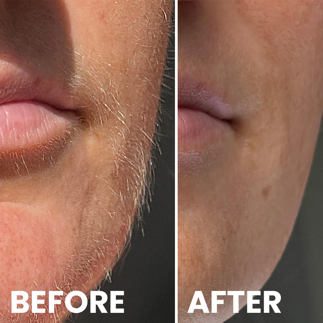 5MINSKIN AT-HOME LASER HÅRFJERNING HÅNDSETT - 72% RABATT INTERNASJONALE KVINNEDAGEN SALG + 4 GRATIS GAVER (VERDI $290)