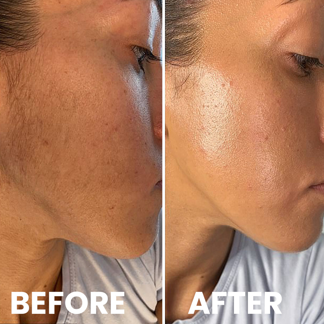 5MINSKIN AT-HOME LASER HÅRFJERNING HÅNDSETT - 72% RABATT INTERNASJONALE KVINNEDAGEN SALG + 4 GRATIS GAVER (VERDI $290)