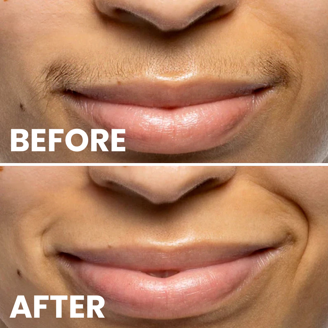 5MINSKIN AT-HOME LASER HÅRFJERNING HÅNDSETT - 72% RABATT INTERNASJONALE KVINNEDAGEN SALG + 4 GRATIS GAVER (VERDI $290)