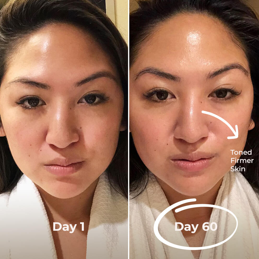 5MinSkin MicroSculpt + Hyaluronsyre Serum (30 Dagers Forsyning)