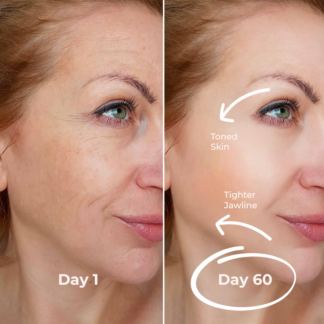 5MinSkin MicroSculpt + Hyaluronsyre Serum (30 Dagers Forsyning)