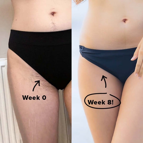 5MINSKIN-HAIR-ZAPPER-2.0 HJEMME-LASER-HÅRFJERNINGS-ENHET