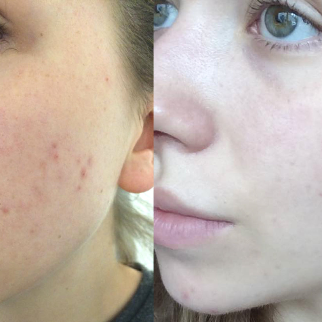 5MinSkin Flekksfjerner