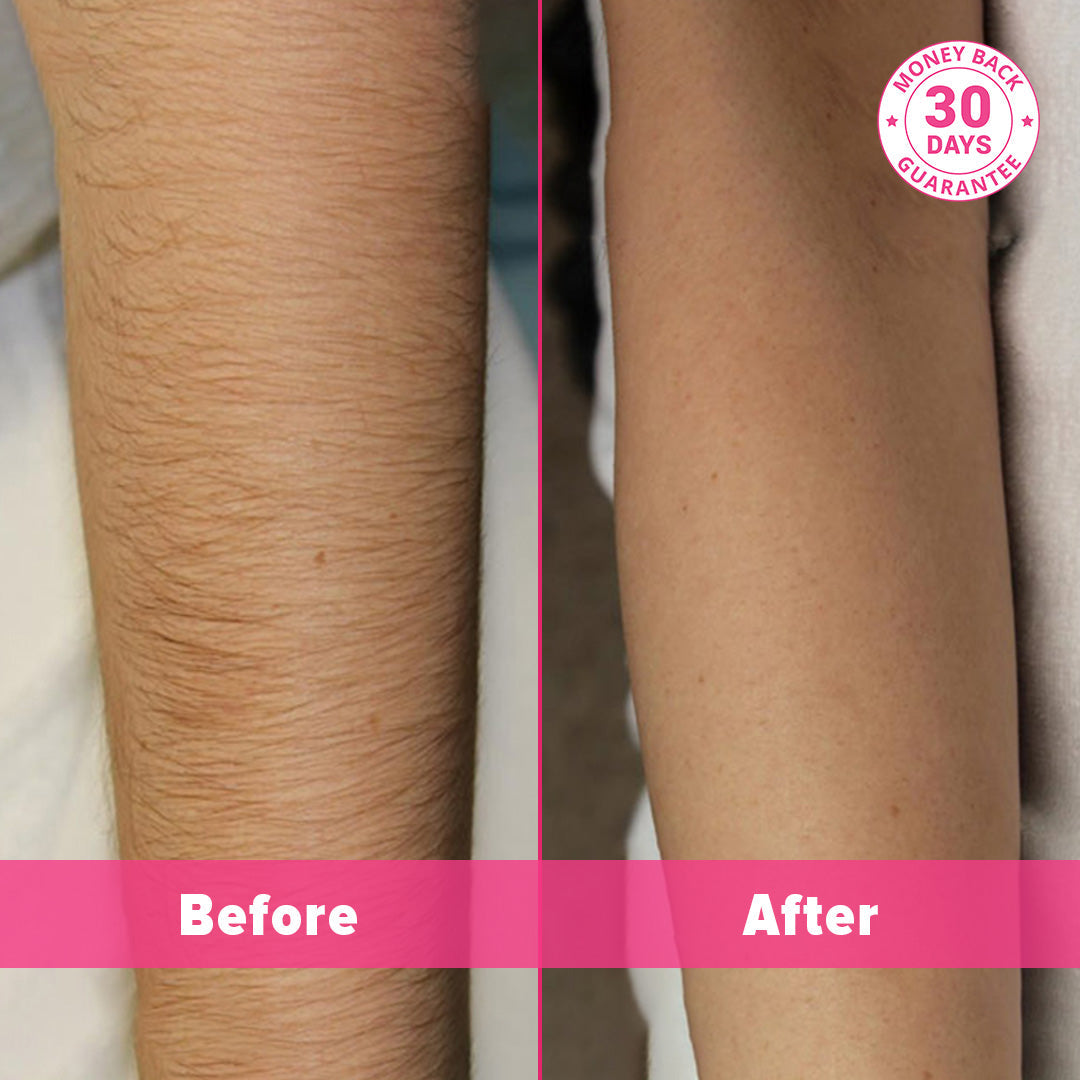 5MINSKIN LASER HÅRFJERNING HÅNDSETT FOR HJEMMEBRUK