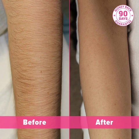 PAIN-FREE-AT-HOME LASER HÅRFJERNING-HÅNDSETT