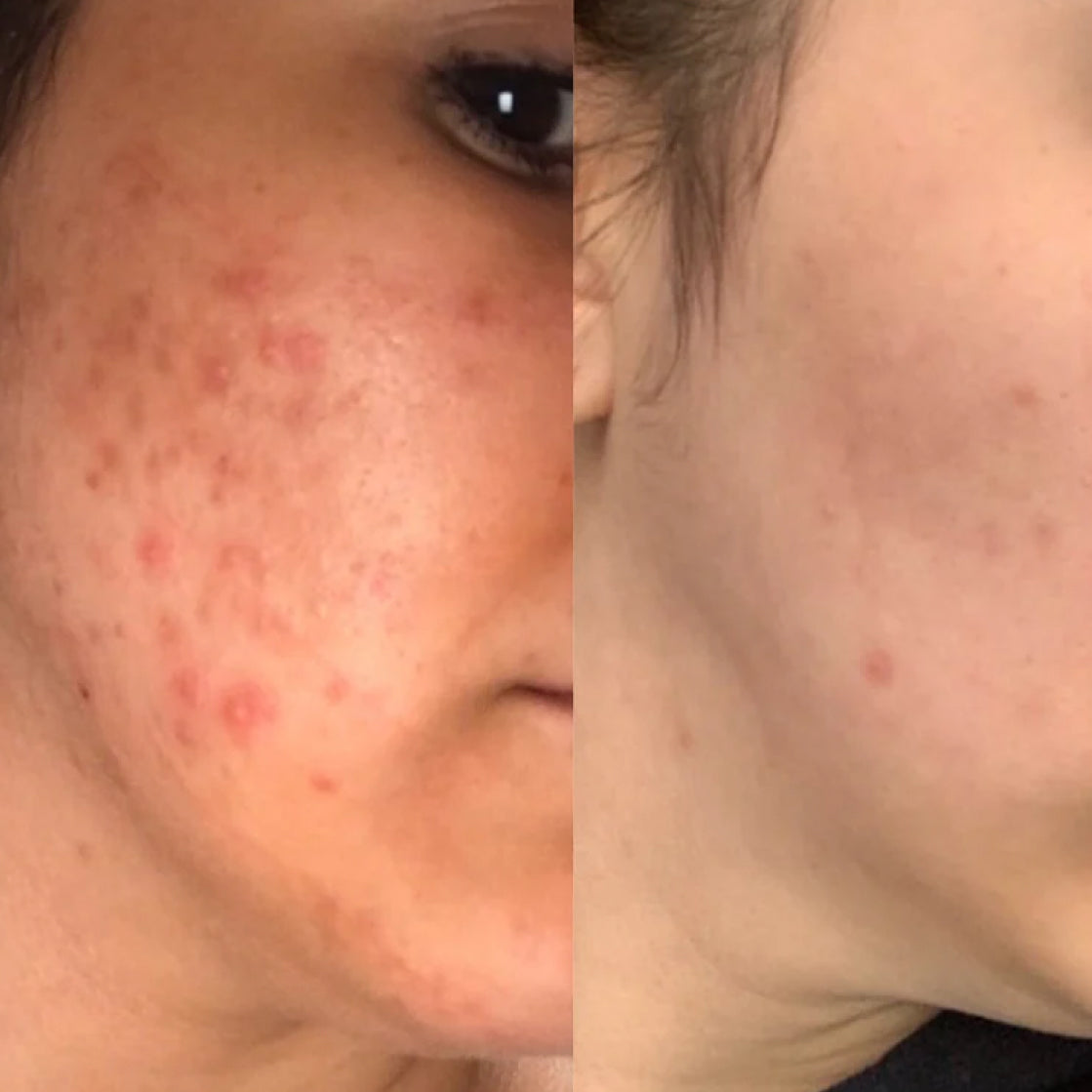 5MinSkin Flekksfjerner